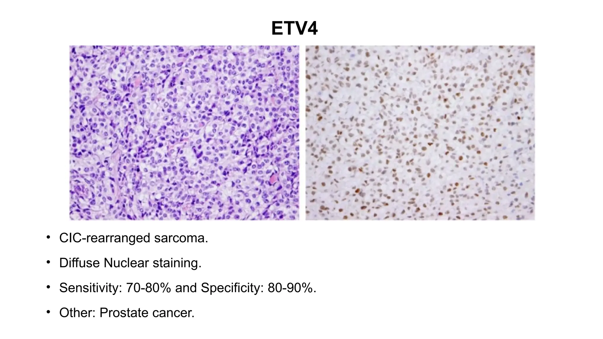 ETV4
• CIC-rearranged sarcoma.
• Diffuse Nuclear staining.
• Sensitivity: 70-80% and Specificity: 80-90%.
• Other: Prostate cancer.
 