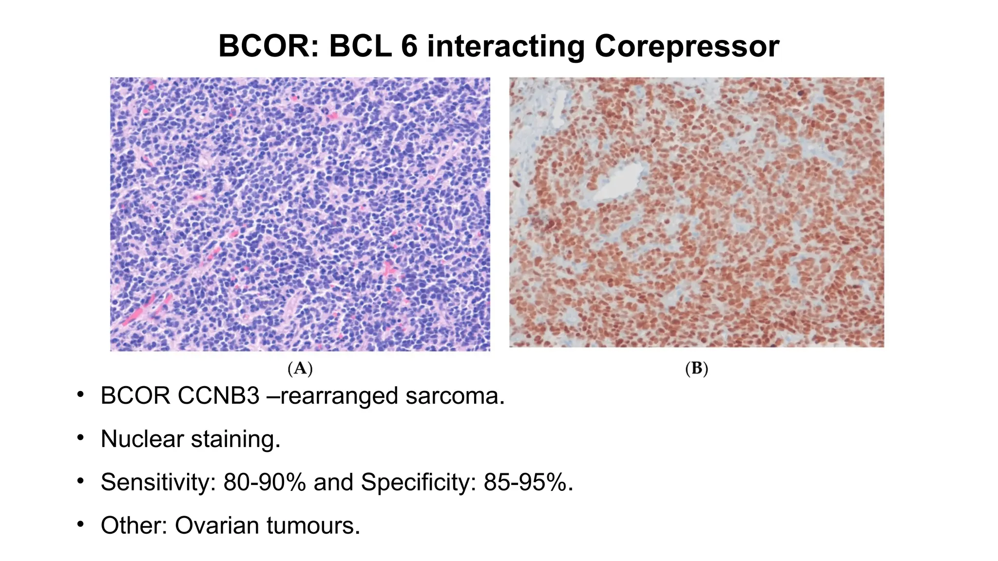BCOR: BCL 6 interacting Corepressor
• BCOR CCNB3 –rearranged sarcoma.
• Nuclear staining.
• Sensitivity: 80-90% and Specificity: 85-95%.
• Other: Ovarian tumours.
 