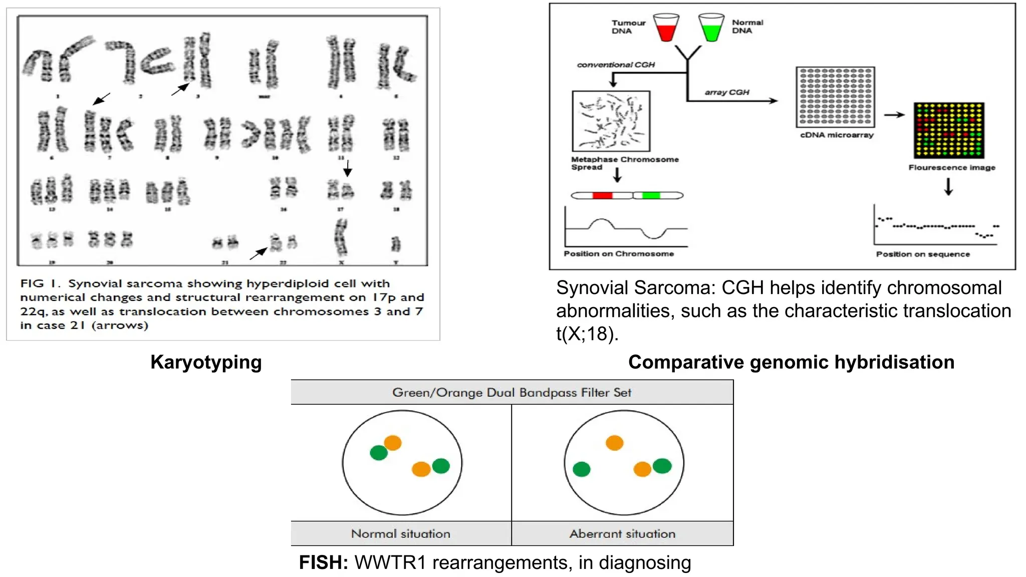 Karyotyping Comparative genomic hybridisation
FISH: WWTR1 rearrangements, in diagnosing
Synovial Sarcoma: CGH helps identify chromosomal
abnormalities, such as the characteristic translocation
t(X;18).
 