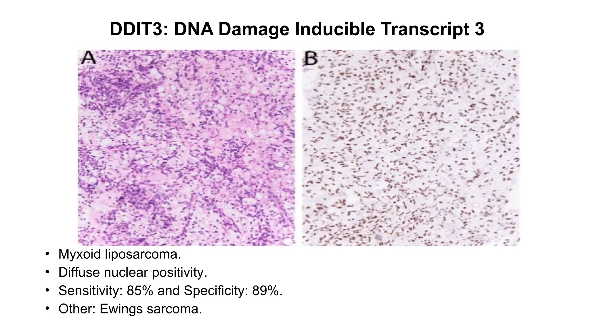 DDIT3: DNA Damage Inducible Transcript 3
• Myxoid liposarcoma.
• Diffuse nuclear positivity.
• Sensitivity: 85% and Specificity: 89%.
• Other: Ewings sarcoma.
 