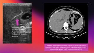 BILIARY TREE RADIOLOGY ADVANCE IMAGING (USG, CT SCAN, MRI AND ERCP) OF