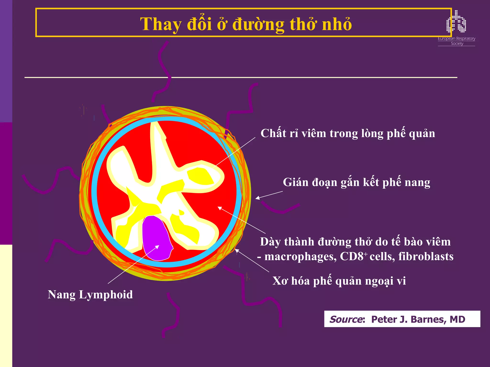 Gián đoạn gắn kết phế nang
Chất rỉ viêm trong lòng phế quản
Xơ hóa phế quản ngoại vi
Nang Lymphoid
Dày thành đường thở do tế bào viêm
- macrophages, CD8+
cells, fibroblasts
Thay đổi ở đường thở nhỏ
Source: Peter J. Barnes, MD
 