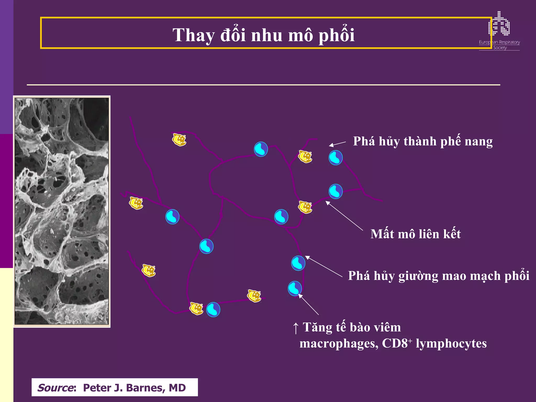 Phá hủy thành phế nang
Mất mô liên kết
Phá hủy giường mao mạch phổi
↑ Tăng tế bào viêm
macrophages, CD8+
lymphocytes
Thay đổi nhu mô phổi
Source: Peter J. Barnes, MD
 