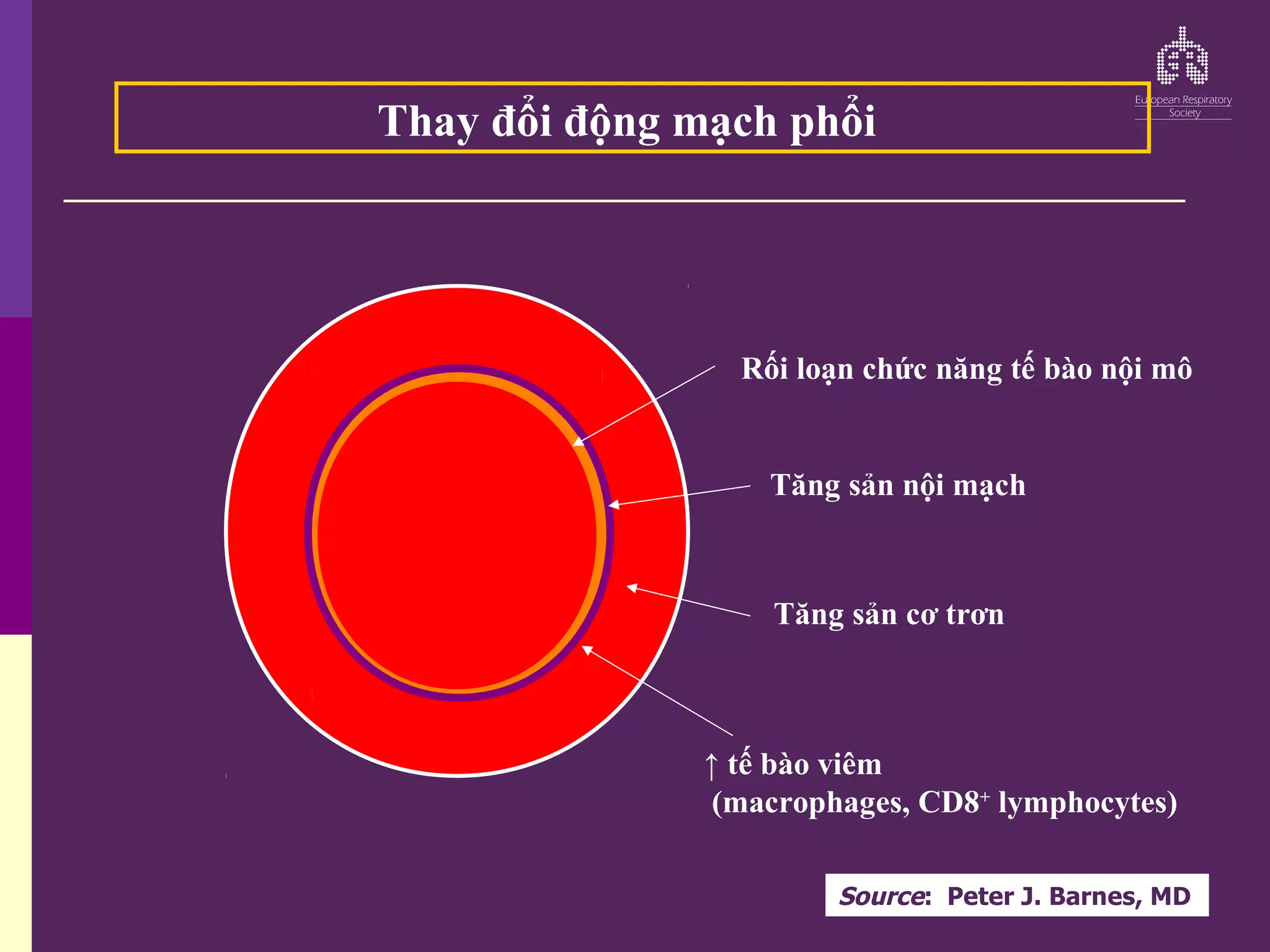 Rối loạn chức năng tế bào nội mô
Tăng sản nội mạch
Tăng sản cơ trơn
↑ tế bào viêm
(macrophages, CD8+
lymphocytes)
Thay đổi động mạch phổi
Source: Peter J. Barnes, MD
 