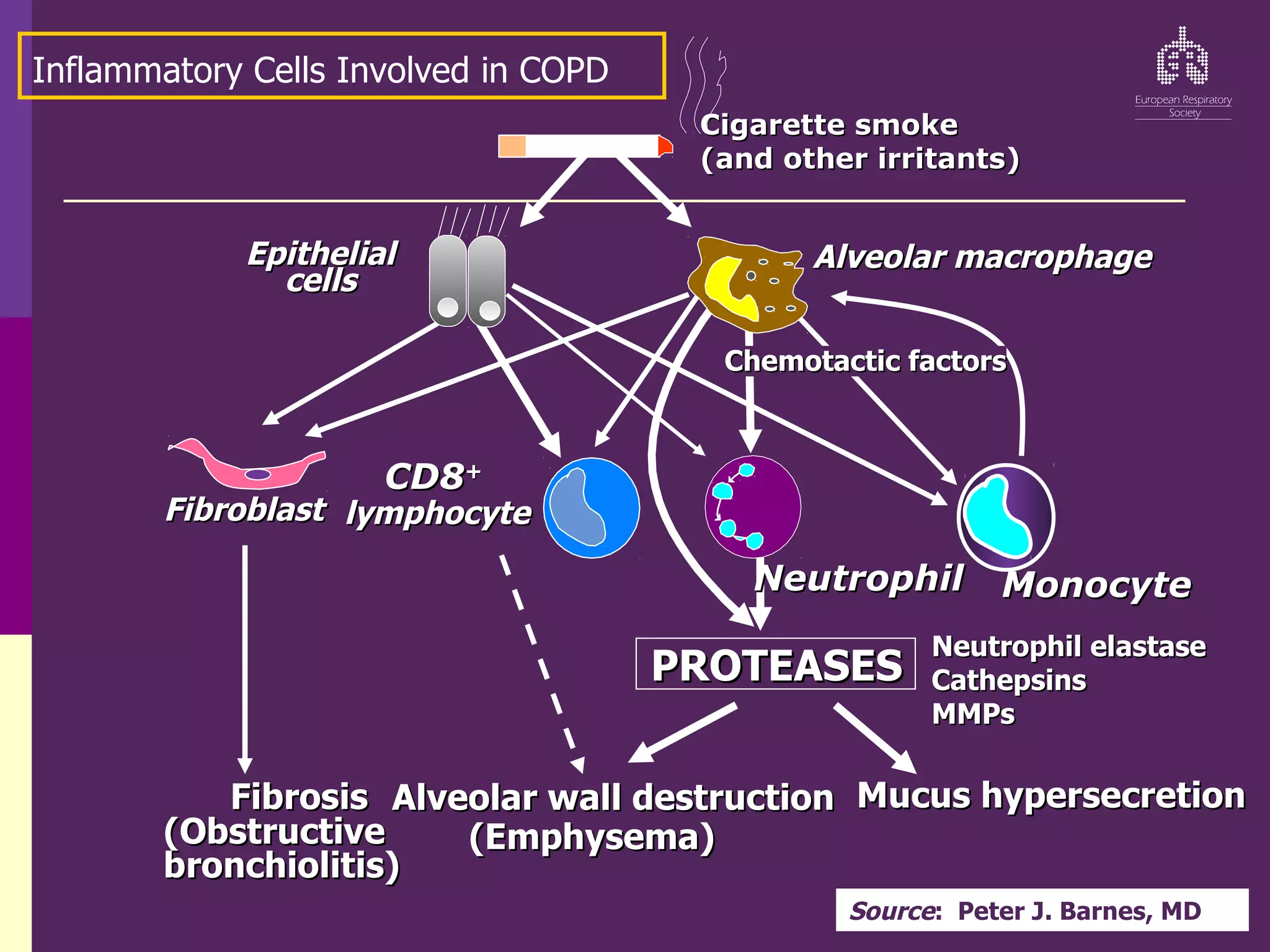 Cigarette smoke
Cigarette smoke
(and other irritants)
(and other irritants)
PROTEASES
PROTEASES
Neutrophil elastase
Neutrophil elastase
Cathepsins
Cathepsins
MMPs
MMPs
Alveolar wall destruction
Alveolar wall destruction
(Emphysema)
(Emphysema)
Mucus hypersecretion
Mucus hypersecretion
CD8
CD8+
+
lymphocyte
lymphocyte
Alveolar macrophage
Alveolar macrophage
Epithelial
Epithelial
cells
cells
Fibrosis
Fibrosis
(Obstructive
(Obstructive
bronchiolitis)
bronchiolitis)
Fibroblast
Fibroblast
Monocyte
Monocyte
Neutrophil
Neutrophil
Chemotactic factors
Chemotactic factors
Inflammatory Cells Involved in COPD
Source: Peter J. Barnes, MD
 