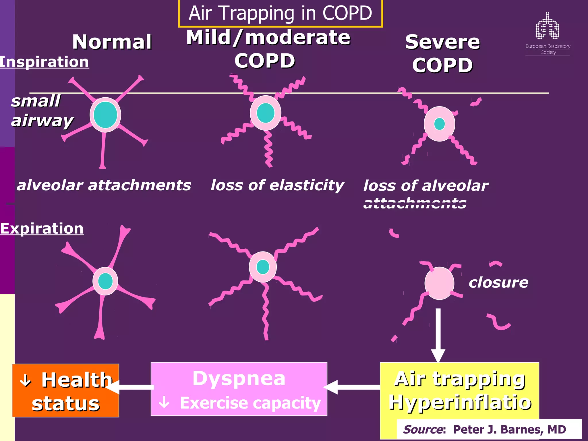 Normal
Normal
Inspiration
Expiration
alveolar attachments
Mild/moderate
Mild/moderate
COPD
COPD
loss of elasticity
Severe
Severe
COPD
COPD
loss of alveolar
attachments
closure
small
small
airway
airway
Dyspnea
↓ Exercise capacity
Air trapping
Air trapping
Hyperinflatio
Hyperinflatio
n
n
↓
↓ Health
Health
status
status
Air Trapping in COPD
Source: Peter J. Barnes, MD
 