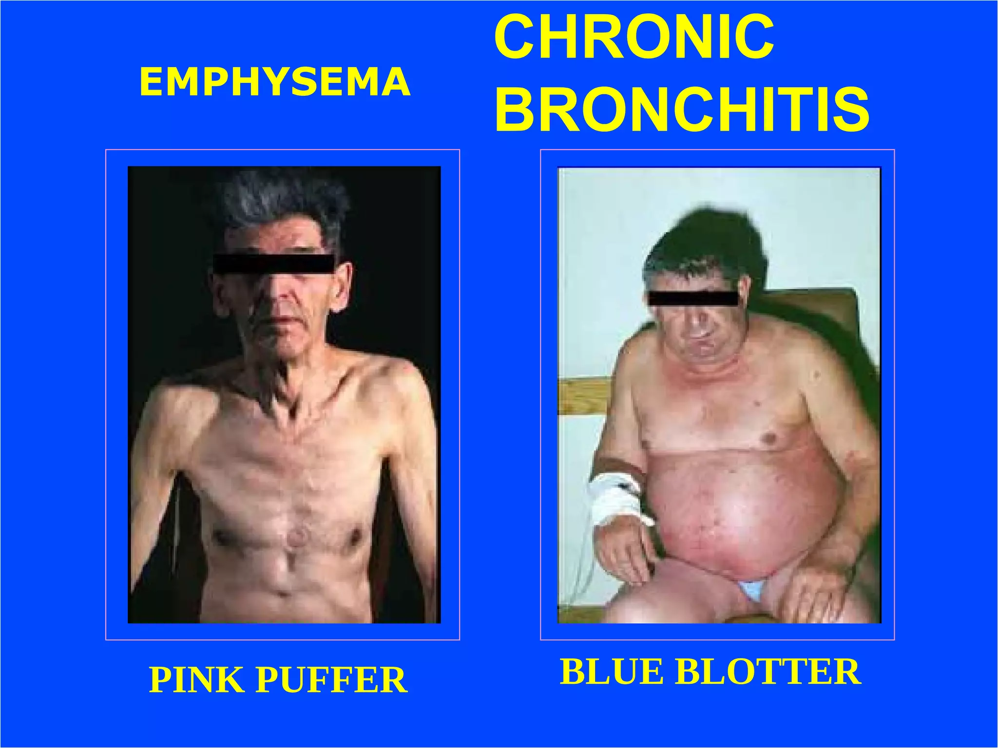 Dr.Sarma@works 25
CHRONIC
BRONCHITIS
EMPHYSEMA
BLUE BLOTTER
PINK PUFFER
 
