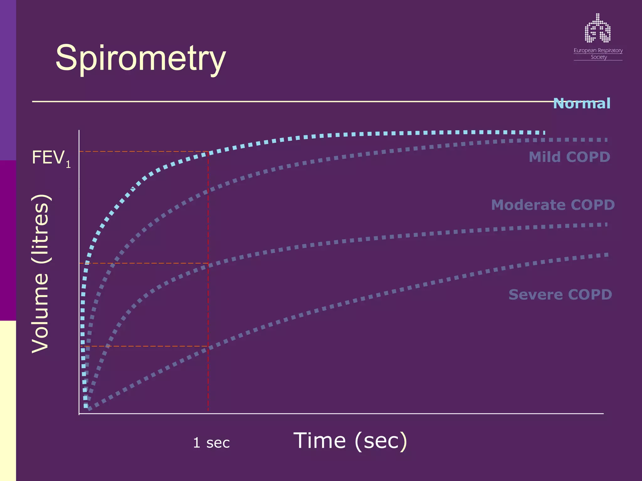 Spirometry
Normal
FEV1
Volume
(litres)
Time (sec)
1 sec
Mild COPD
Moderate COPD
Severe COPD
 