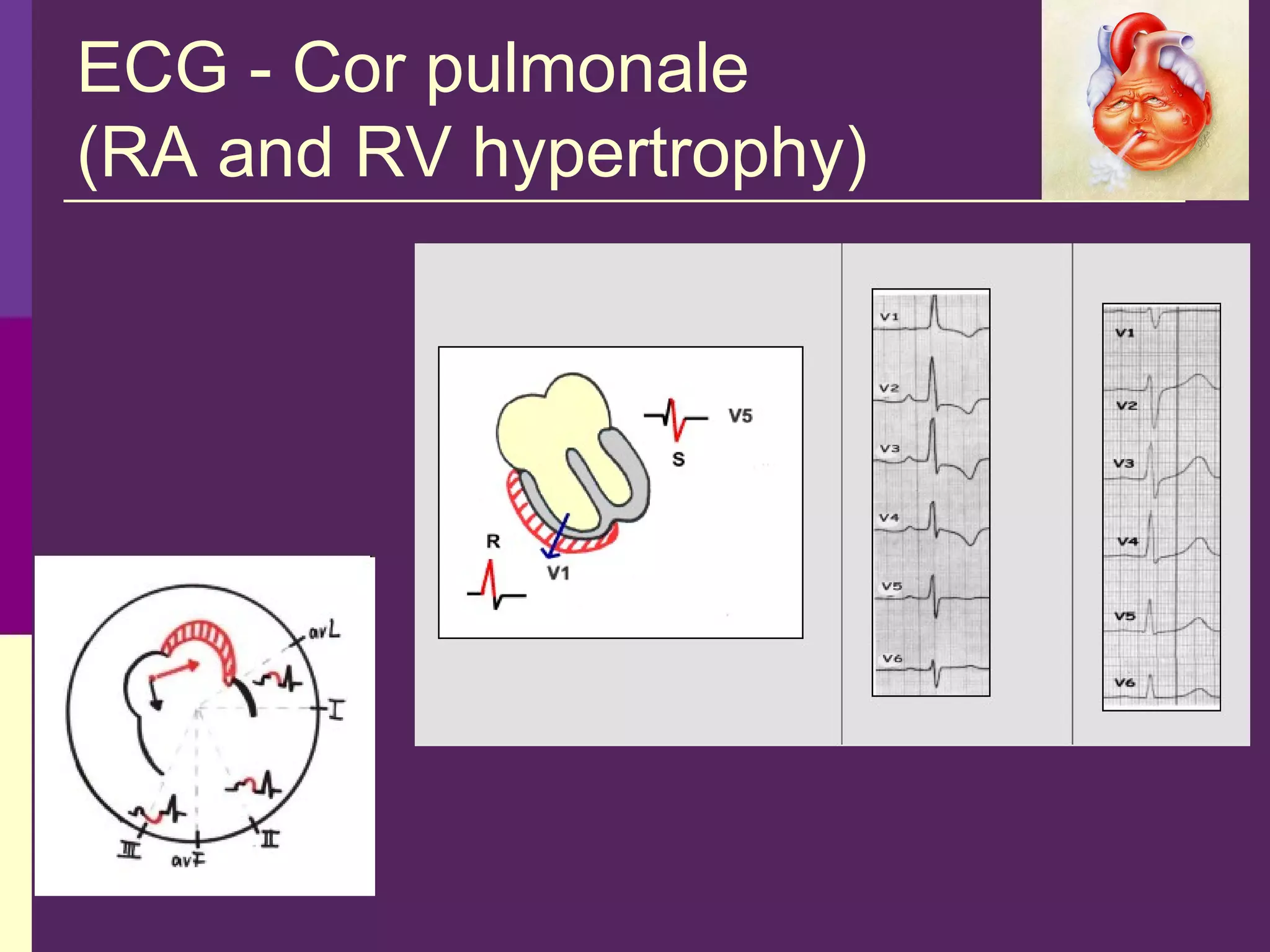 ECG - Cor pulmonale
(RA and RV hypertrophy)
 