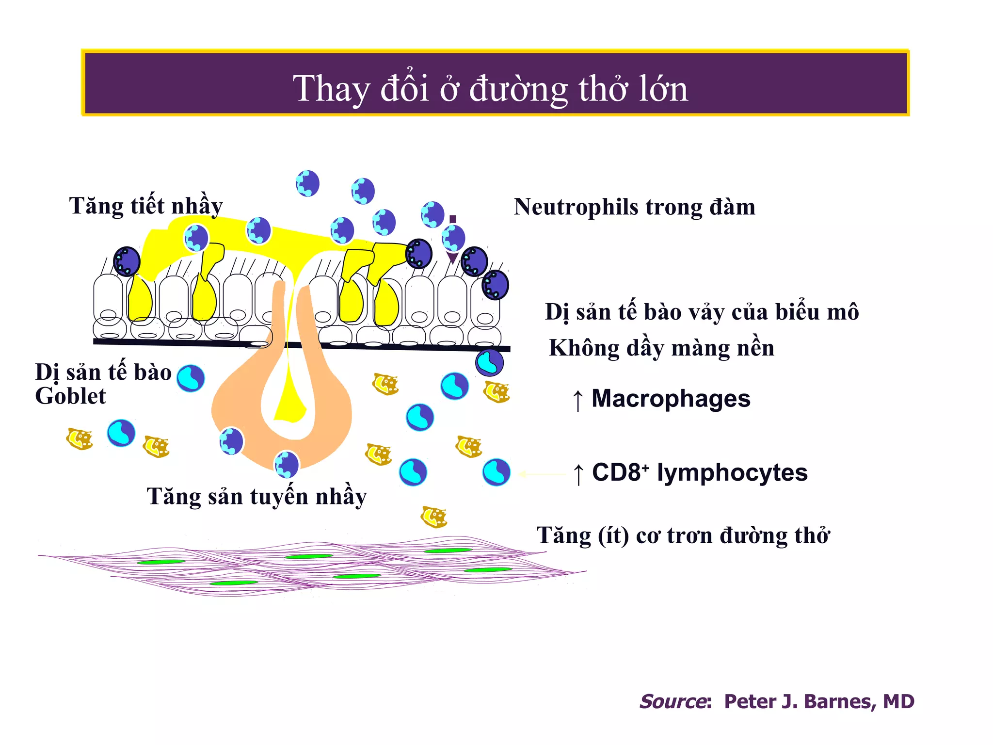 Tăng sản tuyến nhầy
Dị sản tế bào
Goblet
Tăng tiết nhầy Neutrophils trong đàm
Dị sản tế bào vảy của biểu mô
↑ Macrophages
Không dầy màng nền
Tăng (ít) cơ trơn đường thở
↑ CD8+
lymphocytes
Thay đổi ở đường thở lớn
Thay đổi ở đường thở lớn
Source: Peter J. Barnes, MD
 