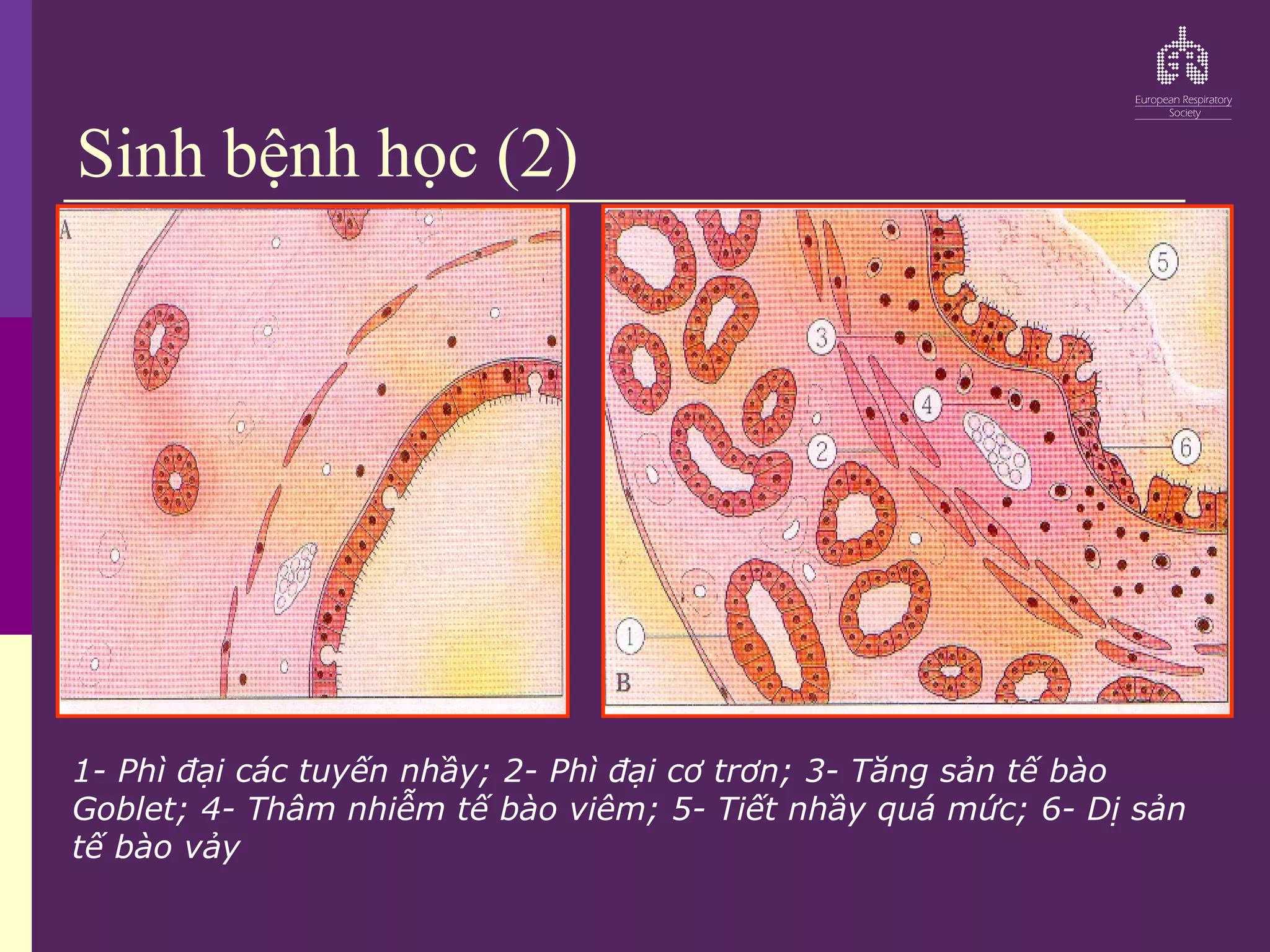 Sinh bệnh học (2)
1- Phì đại các tuyến nhầy; 2- Phì đại cơ trơn; 3- Tăng sản tế bào
Goblet; 4- Thâm nhiễm tế bào viêm; 5- Tiết nhầy quá mức; 6- Dị sản
tế bào vảy
 