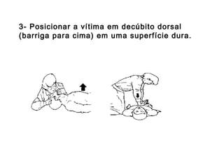 3- Posicionar a vítima em decúbito dorsal
(barriga para cima) em uma superfície dura.

 