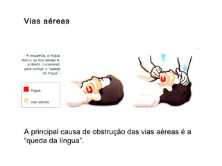 Vias aéreas

A principal causa de obstrução das vias aéreas é a
“queda da língua”.

 