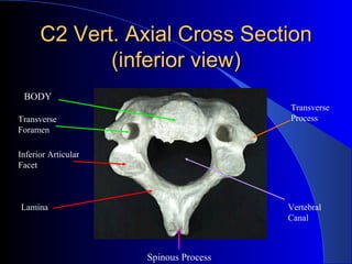 C2 Vert. Axial Cross Section (inferior view) BODY Transverse  Foramen Inferior Articular Facet Lamina Transverse Process V...