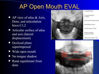 AP Open Mouth EVAL <ul><li>AP view of atlas & Axis, Dens, and articulation btwn C1,2 </li></ul><ul><li>Articular surface o...