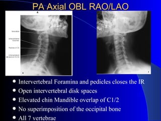 PA Axial OBL RAO/LAO <ul><li>Intervertebral Foramina and pedicles closes the IR </li></ul><ul><li>Open intervertebral disk...
