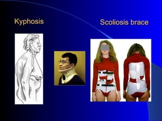 Kyphosis Scoliosis brace 