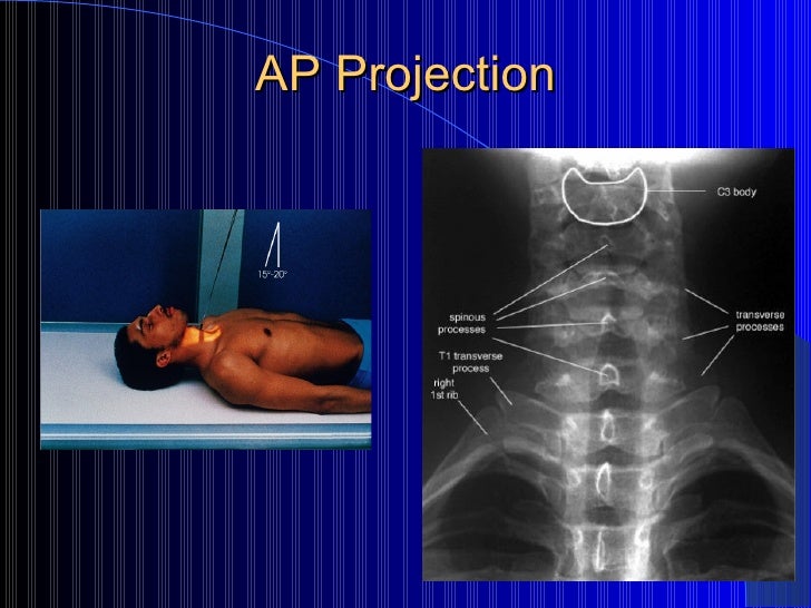 125 Week 11 Cervical Spine