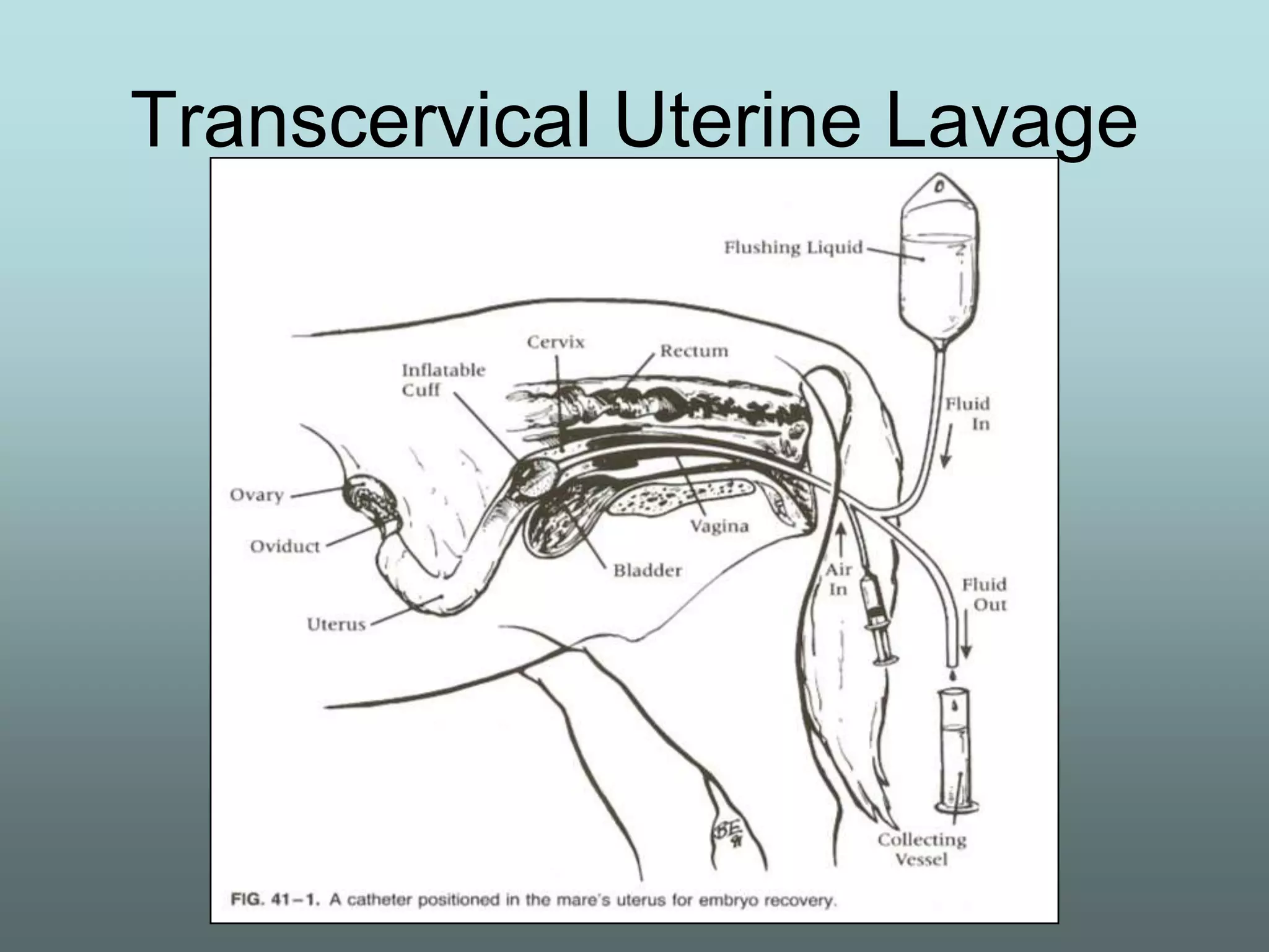 Transcervical Uterine Lavage
 