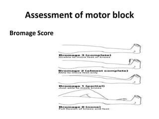 Assessment of motor block
Bromage Score
 
