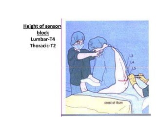 Height of sensory
block
Lumbar-T4
Thoracic-T2
 
