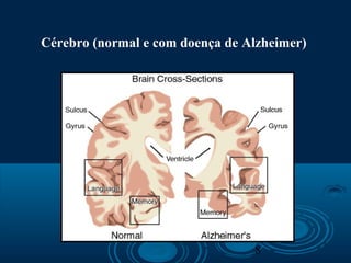 8
Cérebro (normal e com doença de Alzheimer)
 