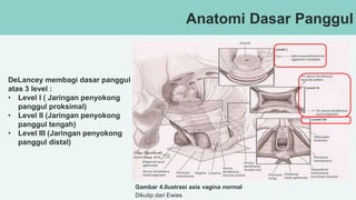 Anatomi Dasar Panggul
Gambar 4.Ilustrasi axis vagina normal
Dikutip dari Ewies
DeLancey membagi dasar panggul
atas 3 level :
• Level I ( Jaringan penyokong
panggul proksimal)
• Level II (Jaringan penyokong
panggul tengah)
• Level III (Jaringan penyokong
panggul distal)
 