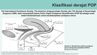 Klasifikasi derajat POP
The International Continence Society, The American Urogynecologic Society, dan The Society of Gynecologic
Surgeons (1996), telah menyepakati bahwa Pelvic Organ Prolapsuse Quantification (POP-Q) sebagai suatu
sistem terstandarisasi untuk mendiskripsikan prolapsus uterus
Gambar 6. Standarisasi stadium prolapsus
uterus berdasarkan klasifikasi POP-Q
Dikutip dari Schorge39
13. Chen B, Wen Y, Polan ML (2004) Elastolytic activity in women with stressurinary incontinence and pelvic organ prolapsuse. Neurourol Urogyn 23: 119-126.
14. Schorge JQ,Schaffer JI,Halvorson LM, Hoffman BL,Bradshaw KD,Cunningham FG. Williams Gynecology. In: Pelvic Organs prolapsused. The McGraw-Hill Companies,inc.2012;p. 633 –655.
 