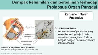 Dampak kehamilan dan persalinan terhadap
Prolapsus Organ Panggul
Kerusakan Saraf
Pudendus
Gambar 9. Perjalanan Saraf Pudensus
Dikutip dari Culligan dkk dan Segedi dkk.15,41
Snooks dan Swash
• Kerusakan saraf pudendus yang
reversibel sering terjadi pada
persalinan pervaginam  dapat
dicegah dengan persalinan secara
seksio sesarea
15, Culligan P.J., Goldberg, R.P. 2007. Urogynecology in Primary Care. London: Springer Verlag London. p.21-33.
 