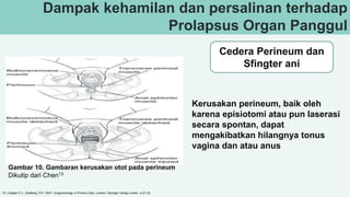 Dampak kehamilan dan persalinan terhadap
Prolapsus Organ Panggul
Cedera Perineum dan
Sfingter ani
15, Culligan P.J., Goldberg, R.P. 2007. Urogynecology in Primary Care. London: Springer Verlag London. p.21-33.
Gambar 10. Gambaran kerusakan otot pada perineum
Dikutip dari Chen13
Kerusakan perineum, baik oleh
karena episiotomi atau pun laserasi
secara spontan, dapat
mengakibatkan hilangnya tonus
vagina dan atau anus
 