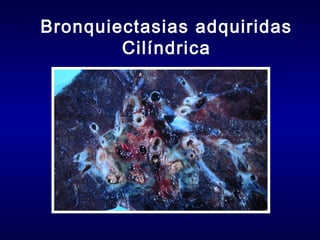 Bronquiectasias adquiridas
Cilíndrica

 