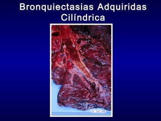 Bronquiectasias Adquiridas
Cilíndrica

 