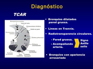 Diagnóstico
TCAR
• Bronquios dilatados
pared gruesa.
• Líneas en Tranvía.
• Radiotransparencia circulares.
- Pared gruesa.
- Acompañando
arteria.

Signo
Anillo
sello

• Bronquios con apariencia
arrosariada

 