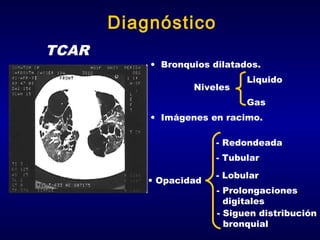 Diagnóstico
TCAR

• Bronquios dilatados.
Niveles

Liquido
Gas

• Imágenes en racimo.
- Redondeada
- Tubular
• Opacidad

- Lobular
- Prolongaciones
digitales
- Siguen distribución
bronquial

 