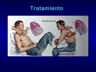 Tratamiento

 