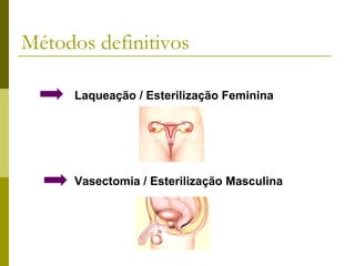 Métodos definitivos
Laqueação / Esterilização Feminina

Vasectomia / Esterilização Masculina

 