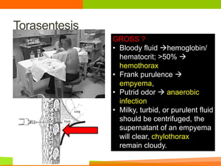 Fluids Putrid Efusi pleura yg masif.ppt