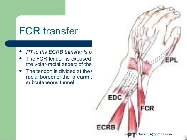 radial nerve palsy fcr tendon