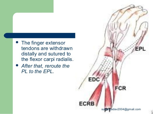radial nerve palsy