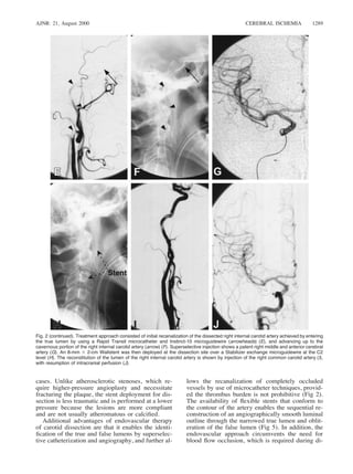 AJNR: 21, August 2000 CEREBRAL ISCHEMIA 1289
Fig. 2 (continued). Treatment approach consisted of initial recanalization of the dissected right internal carotid artery achieved by entering
the true lumen by using a Rapid Transit microcatheter and Instinct-10 microguidewire (arrowheads) (E), and advancing up to the
cavernous portion of the right internal carotid artery (arrow) (F). Superselective injection shows a patent right middle and anterior cerebral
artery (G). An 8-mm 3 2-cm Wallstent was then deployed at the dissection site over a Stabilizer exchange microguidewire at the C2
level (H). The reconstitution of the lumen of the right internal carotid artery is shown by injection of the right common carotid artery (I),
with resumption of intracranial perfusion (J).
cases. Unlike atherosclerotic stenoses, which re-
quire higher-pressure angioplasty and necessitate
fracturing the plaque, the stent deployment for dis-
section is less traumatic and is performed at a lower
pressure because the lesions are more compliant
and are not usually atheromatous or calciﬁed.
Additional advantages of endovascular therapy
of carotid dissection are that it enables the identi-
ﬁcation of the true and false lumens by superselec-
tive catheterization and angiography, and further al-
lows the recanalization of completely occluded
vessels by use of microcatheter techniques, provid-
ed the thrombus burden is not prohibitive (Fig 2).
The availability of ﬂexible stents that conform to
the contour of the artery enables the sequential re-
construction of an angiographically smooth luminal
outline through the narrowed true lumen and oblit-
eration of the false lumen (Fig 5). In addition, the
endovascular approach circumvents the need for
blood ﬂow occlusion, which is required during di-
 