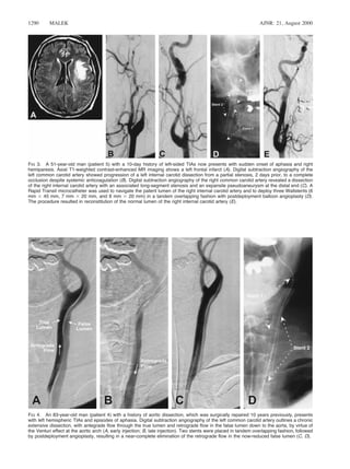 AJNR: 21, August 20001290 MALEK
FIG 3. A 51-year-old man (patient 5) with a 10-day history of left-sided TIAs now presents with sudden onset of aphasia and right
hemiparesis. Axial T1-weighted contrast-enhanced MR imaging shows a left frontal infarct (A). Digital subtraction angiography of the
left common carotid artery showed progression of a left internal carotid dissection from a partial stenosis, 2 days prior, to a complete
occlusion despite systemic anticoagulation (B). Digital subtraction angiography of the right common carotid artery revealed a dissection
of the right internal carotid artery with an associated long-segment stenosis and an expansile pseudoaneurysm at the distal end (C). A
Rapid Transit microcatheter was used to navigate the patent lumen of the right internal carotid artery and to deploy three Wallstents (6
mm 3 45 mm, 7 mm 3 20 mm, and 8 mm 3 20 mm) in a tandem overlapping fashion with postdeployment balloon angioplasty (D).
The procedure resulted in reconstitution of the normal lumen of the right internal carotid artery (E).
FIG 4. An 83-year-old man (patient 4) with a history of aortic dissection, which was surgically repaired 10 years previously, presents
with left hemispheric TIAs and episodes of aphasia. Digital subtraction angiography of the left common carotid artery outlines a chronic
extensive dissection, with antegrade ﬂow through the true lumen and retrograde ﬂow in the false lumen down to the aorta, by virtue of
the Venturi effect at the aortic arch (A, early injection; B, late injection). Two stents were placed in tandem overlapping fashion, followed
by postdeployment angioplasty, resulting in a near-complete elimination of the retrograde ﬂow in the now-reduced false lumen (C, D).
 