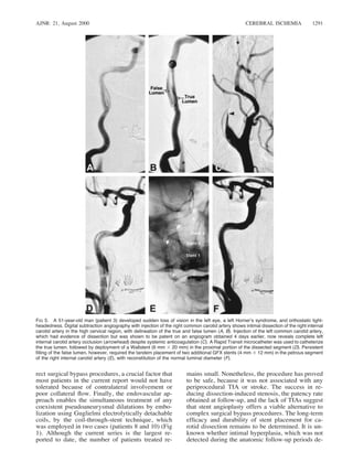 AJNR: 21, August 2000 CEREBRAL ISCHEMIA 1291
FIG 5. A 51-year-old man (patient 3) developed sudden loss of vision in the left eye, a left Horner’s syndrome, and orthostatic light-
headedness. Digital subtraction angiography with injection of the right common carotid artery shows intimal dissection of the right internal
carotid artery in the high cervical region, with delineation of the true and false lumen (A, B). Injection of the left common carotid artery,
which had evidence of dissection but was shown to be patent on an angiogram obtained 4 days earlier, now reveals complete left
internal carotid artery occlusion (arrowhead) despite systemic anticoagulation (C). A Rapid Transit microcatheter was used to catheterize
the true lumen, followed by deployment of a Wallstent (6 mm 3 20 mm) in the proximal portion of the dissected segment (D). Persistent
ﬁlling of the false lumen, however, required the tandem placement of two additional GFX stents (4 mm 3 12 mm) in the petrous segment
of the right internal carotid artery (E), with reconstitution of the normal luminal diameter (F).
rect surgical bypass procedures, a crucial factor that
most patients in the current report would not have
tolerated because of contralateral involvement or
poor collateral ﬂow. Finally, the endovascular ap-
proach enables the simultaneous treatment of any
coexistent pseudoaneurysmal dilatations by embo-
lization using Guglielmi electrolytically detachable
coils, by the coil-through-stent technique, which
was employed in two cases (patients 8 and 10) (Fig
1). Although the current series is the largest re-
ported to date, the number of patients treated re-
mains small. Nonetheless, the procedure has proved
to be safe, because it was not associated with any
periprocedural TIA or stroke. The success in re-
ducing dissection-induced stenosis, the patency rate
obtained at follow-up, and the lack of TIAs suggest
that stent angioplasty offers a viable alternative to
complex surgical bypass procedures. The long-term
efﬁcacy and durability of stent placement for ca-
rotid dissection remains to be determined. It is un-
known whether intimal hyperplasia, which was not
detected during the anatomic follow-up periods de-
 