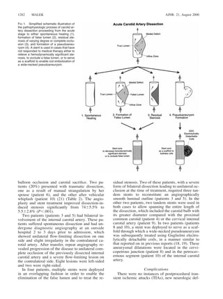 AJNR: 21, August 20001282 MALEK
FIG 1. Simpliﬁed schematic illustration of
the pathophysiologic process of carotid ar-
tery dissection proceeding from the acute
stage to either spontaneous healing (1),
formation of false lumen (2), residual ste-
nosis of varying degree or complete occlu-
sion (3), and formation of a pseudoaneu-
rysm (4). A stent is used in cases that have
not responded to medical therapy either to
relieve a hemodynamically signiﬁcant ste-
nosis, to occlude a false lumen, or to serve
as a scaffold to enable coil embolization of
a wide-necked pseudoaneurysm.
balloon occlusion and carotid sacriﬁce. Two pa-
tients (20%) presented with traumatic dissection,
one as a result of manual strangulation by her
spouse (patient 6), and the other after vehicular
whiplash (patient 10) (21) (Table 2). The angio-
plasty and stent treatment improved dissection-in-
duced stenosis signiﬁcantly from 7465.5% to
5.562.8% (P,.001).
Two patients (patients 3 and 5) had bilateral in-
volvement of the internal carotid artery. These pa-
tients suffered spontaneous dissection and had un-
dergone diagnostic angiography at an outside
hospital 2 to 3 days prior to admission, which
showed unilateral ﬂow-limiting dissection on one
side and slight irregularity in the contralateral ca-
rotid artery. After transfer, repeat angiography re-
vealed progression of the disease to unilateral com-
plete occlusion of the previously dissected internal
carotid artery and a severe ﬂow-limiting lesion on
the contralateral side. Eight lesions were left-sided
and two were right-sided.
In four patients, multiple stents were deployed
in an overlapping fashion in order to enable the
elimination of the false lumen and to treat the re-
sidual stenosis. Two of these patients, with a severe
form of bilateral dissection leading to unilateral oc-
clusion at the time of treatment, required three tan-
dem stents to reconstitute an angiographically
smooth luminal outline (patients 3 and 5). In the
other two patients, two tandem stents were used in
both cases to allow spanning the entire length of
the dissection, which included the carotid bulb with
its greater diameter compared with the proximal
common carotid (patient 4) or the cervical internal
carotid artery (patient 9). In two patients (patients
8 and 10), a stent was deployed to serve as a scaf-
fold through which a wide-necked pseudoaneurysm
was subsequently treated using Guglielmi electro-
lytically detachable coils, in a manner similar to
that reported on in previous reports (18, 19). These
aneurysmal dilatations were located in the cervi-
copetrous junction (patient 8) and in the petrocav-
ernous segment (patient 10) of the internal carotid
artery.
Complications
There were no instances of postprocedural tran-
sient ischemic attacks (TIAs), new neurologic def-
 