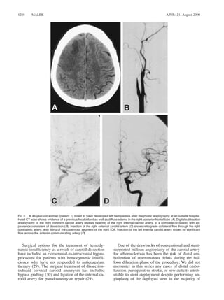 AJNR: 21, August 20001288 MALEK
FIG 2. A 45-year-old woman (patient 1) noted to have developed left hemiparesis after diagnostic angiography at an outside hospital.
Head CT scan shows evidence of a previous focal infarct as well as diffuse edema in the right posterior frontal lobe (A). Digital subtraction
angiography of the right common carotid artery reveals tapering of the right internal carotid artery, to a complete occlusion, with ap-
pearance consistent of dissection (B). Injection of the right external carotid artery (C) shows retrograde collateral ﬂow through the right
ophthalmic artery, with ﬁlling of the cavernous segment of the right ICA. Injection of the left internal carotid artery shows no signiﬁcant
ﬂow across the anterior communicating artery (D).
Surgical options for the treatment of hemody-
namic insufﬁciency as a result of carotid dissection
have included an extracranial-to-intracranial bypass
procedure for patients with hemodynamic insufﬁ-
ciency who have not responded to anticoagulant
therapy (29). The surgical treatment of dissection-
induced cervical carotid aneurysm has included
bypass grafting (30) and ligation of the internal ca-
rotid artery for pseudoaneurysm repair (29).
One of the drawbacks of conventional and stent-
supported balloon angioplasty of the carotid artery
for atherosclerosis has been the risk of distal em-
bolization of atheromatous debris during the bal-
loon dilatation phase of the procedure. We did not
encounter in this series any cases of distal embo-
lization, perioperative stroke, or new deﬁcits attrib-
utable to stent deployment despite performing an-
gioplasty of the deployed stent in the majority of
 