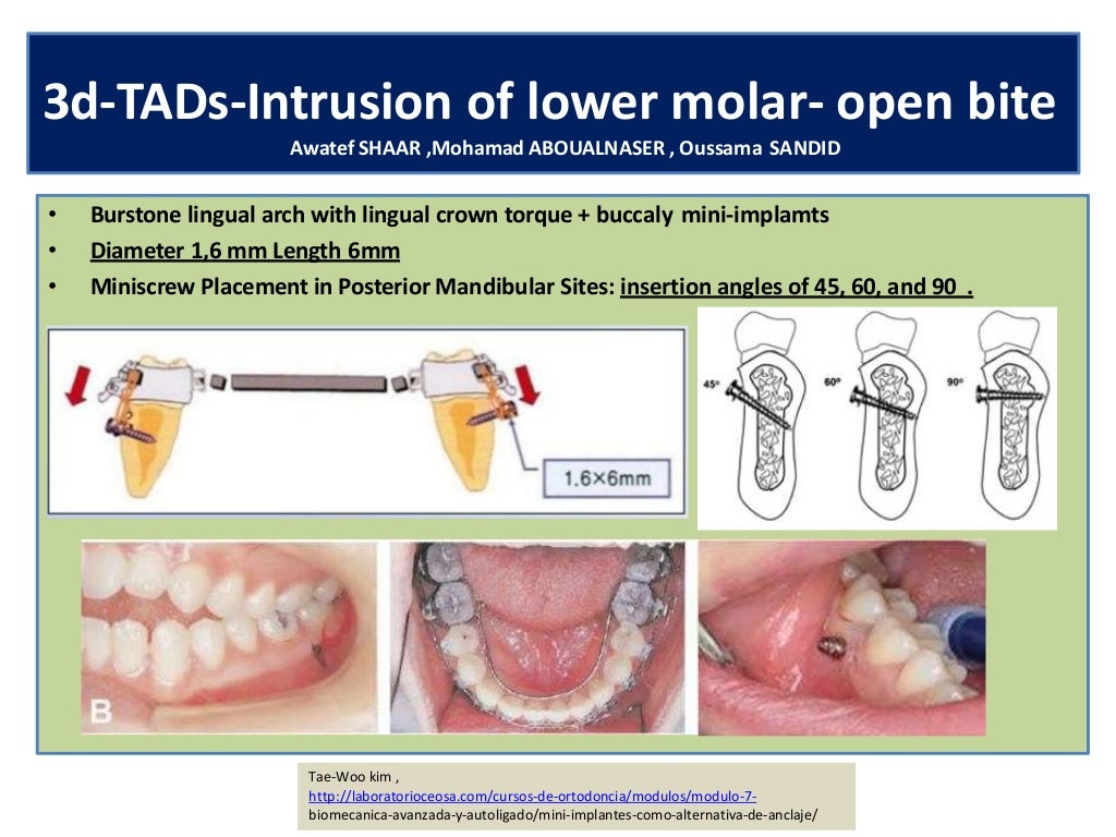 129 temporary anchorage devices in orthodonticsminiscrewsminiimpla…