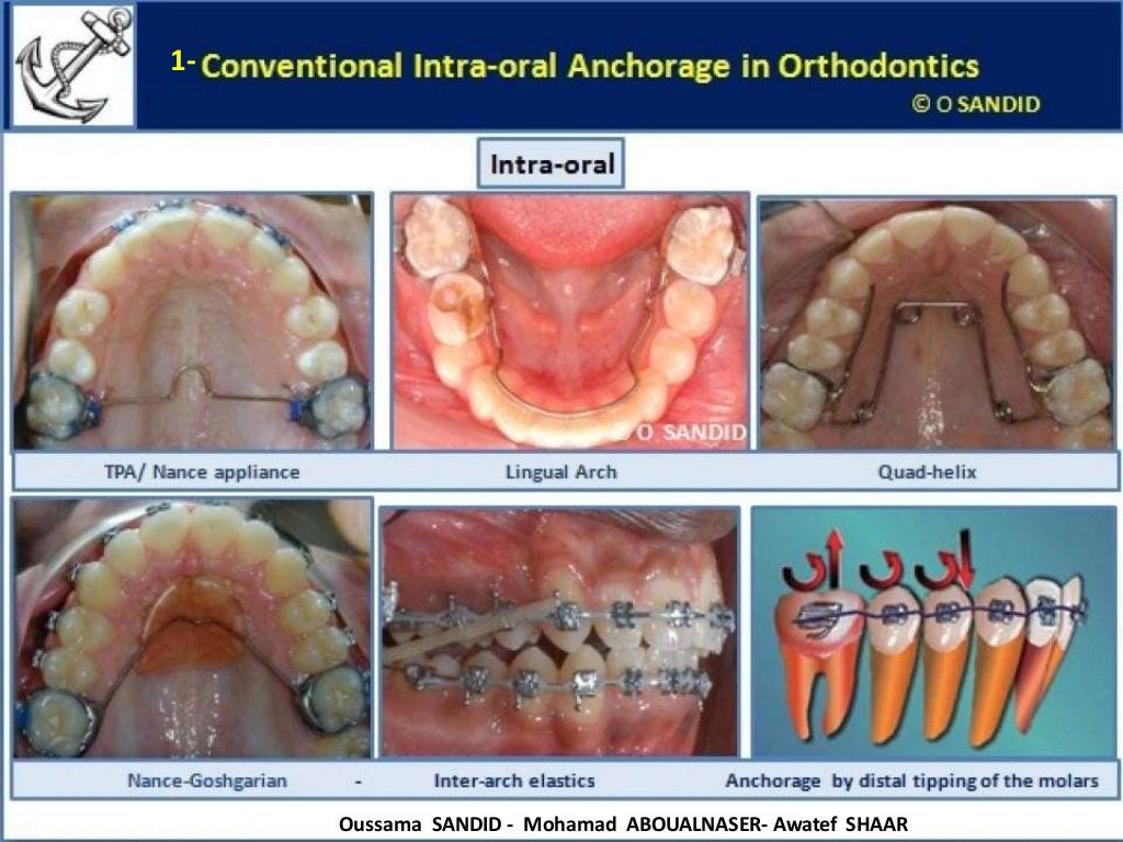 129 temporary anchorage devices in orthodonticsminiscrewsminiimpla…