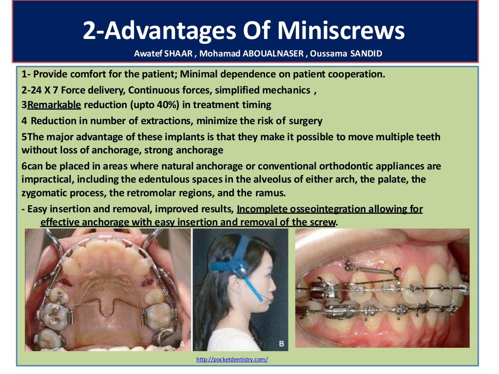 129 temporary anchorage devices in orthodonticsminiscrewsminiimpla…