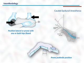 Anesthesiology
Caudal Epidural Anesthesia
Prone jackknife position
Position lateral or prone with
one or both hips flexed
 