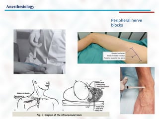 Anesthesiology
Peripheral nerve
blocks
 
