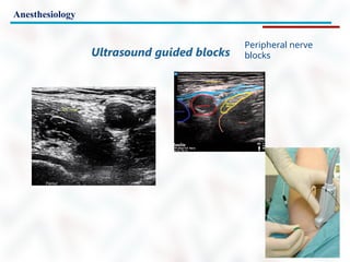 Anesthesiology
Peripheral nerve
blocks
Ultrasound guided blocks
 